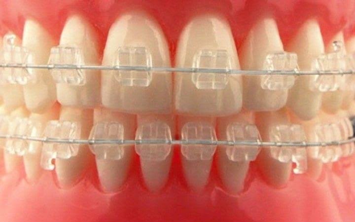 CERAMIC BRACE product image