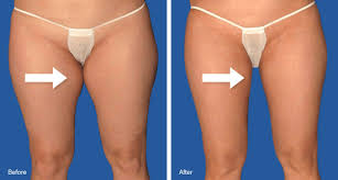 Stubborn Inner Thigh Fat Beauty Fashion Pretty Ugly Little Liar