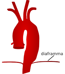 Approfondiamo le caratteristiche e le tipologie dell'aneurisma. File Aneurisma Dell Aorta Toracica Svg Wikimedia Commons