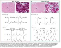 Image result for Myocarditis
