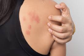 What To Do When Stress Gives You Hives The American Institute Of Stress