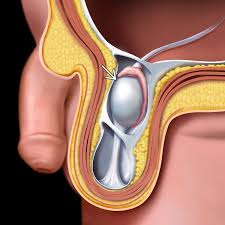 Image result for Undescended Testicle