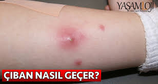 Ciban Neden Cikar Ve Ciban Nasil Gecer Yasamloji