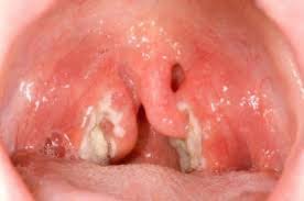 Image result for Physical injury red spots roof of mouth