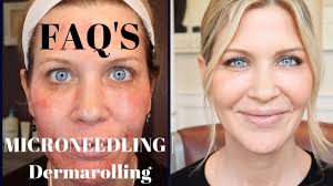 Maybe you would like to learn more about one of these? Microneedling Dermarolling Q A Before During And After Pics Youtube