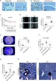 Colon cancer is currently the fourth most common cancer diagnosed in the united states. Pals1 Prevents Rac1 Dependent Colorectal Cancer Cell Metastasis By Inhibiting Arf6 Molecular Cancer Full Text