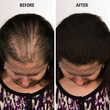 Cuvva is a step up in quality (and price) from the other best hair loss concealers so far in this list. 10 Best Hair Loss Concealer Reviews In 2020 Hold The Hairline