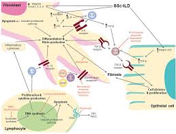 Interstitial Lung Disease In Systemic Sclerosis Focus On Early Detect Oarrr