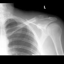 Breast tissue extends from your collarbone to your underarm and rib cage. Breast Cancer Metastasis To Distal Clavicle Pathological Fracture Radiology Case Radiopaedia Org