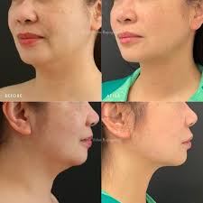 Say goodbye to your double chin for good! Our signature AirContour Lipo™  for the submental chin area has been a top choice for many patients at our  practice. It's a highly effective