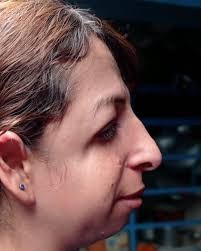 Rostros Treacher Collins...