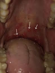 Image result for Hand foot and mouth disease HFMD roof of mouth