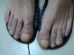 Image result for Clubbing nails feet