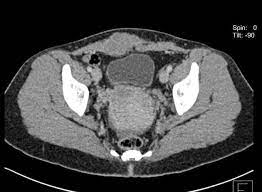Ct stands for computed tomography. Abdominal Wall Endometriosis Post C Section Radiology Case Radiopaedia Org
