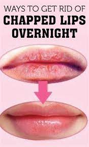Mtidavis.com - Is Kissing Good For Chapped Lips Remedy