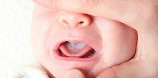 Pada bayi tidak mau menyusu biasa dikarenakan beberapa kondisi salah satunya adalah rasa asi yang berubah atau aroma moms yang berubah. Lidah Bayi Putih Tak Selalu Disebabkan Asi Begini Cara Mengatasinya Theasianparent Indonesia