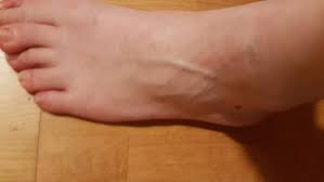 Wer mit dem fuß umknickt, der muss nicht immer direkt einen arzt konsultieren. Mit Fuss Umgeknickt Zum Arzt Gesundheit Unfall