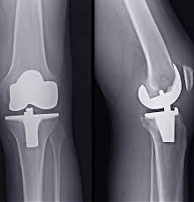 What does revision surgery mean? Knee Replacement Surgery Principle Orthopaedics Frankston