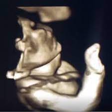 anne karninda bebek ezilir mi kadin hastaliklari