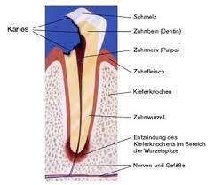 Granulom Furini Lorenz Zahnarzt Dentista Gais