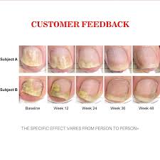 Image result for Paronychia feet