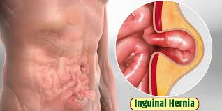 Inguinal Hernia: Types, Causes, Symptoms & Treatment - Dr Abhijit Gotkhinde