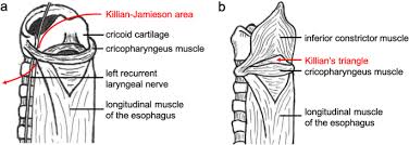 Check spelling or type a new query. Surgery For Killian Jamieson Diverticulum A Report Of Two Cases Surgical Case Reports Full Text