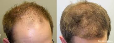 Another picture of hair cloning bernstein: Hair Loss Treatment Prevent Hair Loss Bernstein Medical