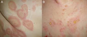Image result for Pemphigoid