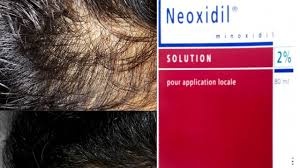 تجربتي مع تساقط الشعر و Minoxidil Youtube