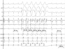This is used in attempts to capture and terminate tachycardias or, in some cases, to try to trigger and study. Ventricular Overdrive Pacing During Narrow Qrs Tachycardia What Are The Circuits Involved Authorea