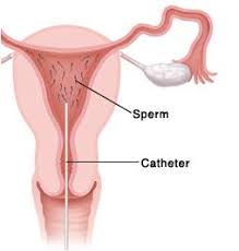Preparing for an iui cycle. Can Double Intrauterine Insemination Iui Improve Pregnancy Outcomes Austin Fertility Reproductive Medicine
