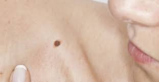 Itchy Mole Causes Treatment And Symptoms