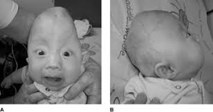 Sensenbrenner syndrome (Cranioectodermal dysplasia): Clinical and molecular  analyses of 39 patients including two new patients