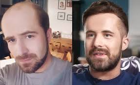 Mens toupee hair pieces with remy monofilament short length wavy style human hair wigs. Men S Hairpieces Before And After Video Stories From Customers