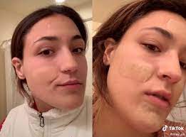What do you need to know about hydrocolloid dressings? Tiktok Trend Sees People Using Hydrocolloid Bandages To Treat Acne The Independent