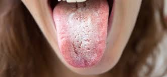 Image result for oral thrush symptoms roof of the mouth