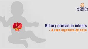 Maybe you would like to learn more about one of these? How To Treat Biliary Atresia A Rare Digestive Disease In Infants