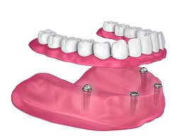 Amazing dental care in a relaxed and friendly office. Dentures St Pete Beach Fl Denture Dentist St Pete Beach Florida