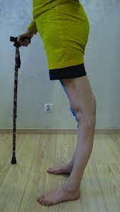Before you start doing any of the suggested exercises, it is important to consult your doctor first. Charcot Marie Tooth Syndrome Knees Hyperextended In Standing Position Download Scientific Diagram