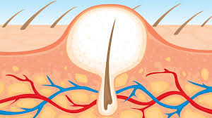 ingrown hair causes symptoms