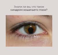 Синдром кошачьего глаза (Coloboma) — редкое и загадочное ...