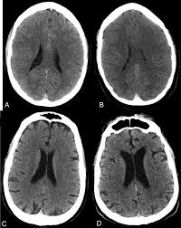 Image result for Sinus CT