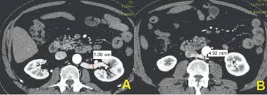 Scielo Brasil Compressoes Das Veias Renal E Iliaca Comum Esquerdas Em Tomografias Computadorizadas Com Que Frequencia Sao Detectadas Compressoes Das Veias Renal E Iliaca Comum Esquerdas Em Tomografias Computadorizadas Com