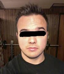 Ugly hairline all of your opponents pokemon have fainted. I M 27 Years Old And My Hairline Has Noticeably Receded Over The Past Few Years Estimation On Number Of Hair Grafts Photo