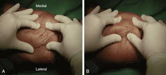 Image result for Ballottable Patella Sign