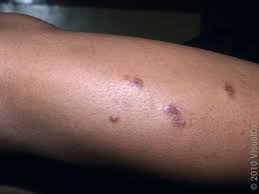 Image result for scabies bite