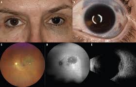 Image result for melanosis sclera