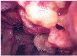 Your guide to mesothelioma, including what it is, the different types and stages it has, the treatments available and how to cope with your diagnosis. Mesothelioma Thoracic Key