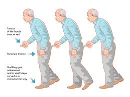 Tremors are common, but the disorder also commonly causes stiffness or slowing of movement. Early Signs Of Parkinson S Disease Griswold Home Care